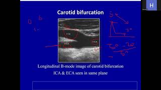 carotid Doppler ultrasound amp renal Doppler ultrasoundleap training [upl. by Iramohs]