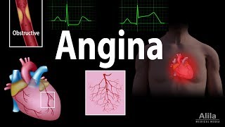 Angina Stable Unstable Microvascular and Prinzmetal Animation [upl. by Mcclary71]