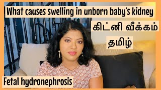 கிட்னி வீக்கம்  Fetal hydronephrosis Tamil Swelling in baby’s kidney in pregnancy  Kidney veekkam [upl. by Eniamurt908]