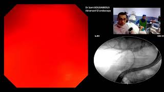 ERCP for hepatic duct neopalsic stricture [upl. by Dorn]