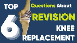 Top 6 tips about Revision Knee Replacement surgery [upl. by Cates842]