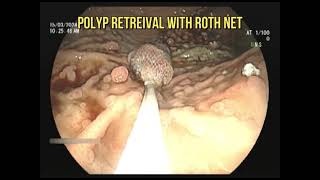 Rescuing a Polyp  A tricky endoscopy [upl. by Lorna570]