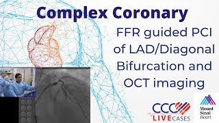 FFR guided PCI of LADDiagonal Bifurcation and OCT imaging  CCC Live April 2016 [upl. by Adnwahs]