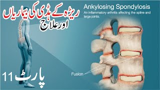 Ankylosing spondylitis Treatment [upl. by Kalfas]