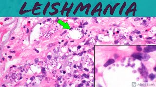 Leishmaniasis Leishmania Infection 5Minute Pathology Pearls ‪Dermatology Dermatopathology [upl. by Alliuqaj]