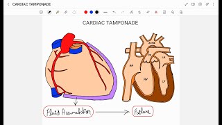 CARDIAC TAMPONADE [upl. by Nairda]