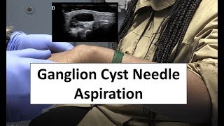 Needle Aspiration of a Ganglion Cyst [upl. by Woodrow1]