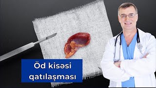 Öd Qatılaşması Müalicəsi və Öd Kisəsi Xəstəliklərinin Əlamətləri [upl. by Sadowski449]