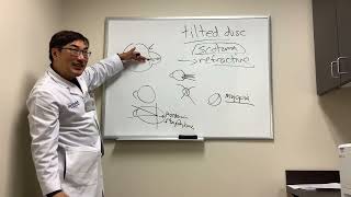 Scotoma in Tilted Disc Syndrome [upl. by Danete]