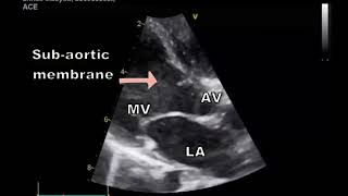 Tips and tricks of VSD echocardiography Ventricular Septal Defect [upl. by Aibonez]