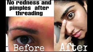 How you can remove redness and pimples after threading [upl. by Aicena]