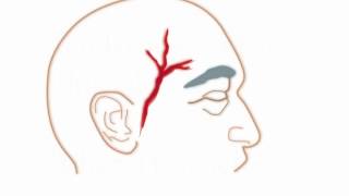 TIP 5  Headache with tender temples [upl. by Colyer]