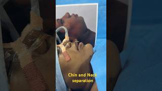 Best RARE Chin and Neck Separation Plastic Surgery to Make Face Beautiful in India [upl. by Ligriv]