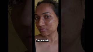 Tretinoin journey of 6 months skincare influencer tretinoin skincareroutine youtubeshorts [upl. by Pirzada]