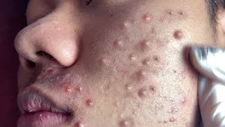 Big Cystic Acne Blackheads Extraction Blackheads amp Milia Whiteheads Removal Pimple Popping [upl. by Nueormahc809]