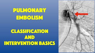 PE Classification amp Intervention Basics [upl. by Ainnet]