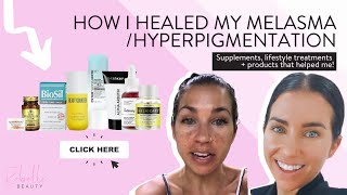 How I Healed My MelasmaHyperpigmentation 2021 Updates Products Supplements and Treatments [upl. by Ellenij]