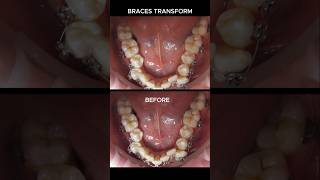 Braces transformation 26 months braces orthodontist dentist [upl. by Amuwkuhc]