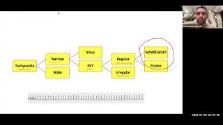 Arrhythmia lectures Tachyarrhythmias By prof Mohamed Ibrahim [upl. by Namyaw]