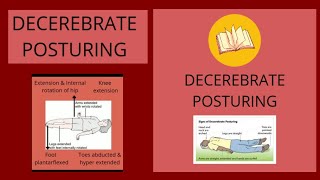 DECEREBRATE POSTUREAbnormal Posturing [upl. by Anirdua455]