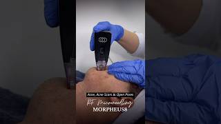 Acne amp Acne Scars  Morpheus8 RF Microneedling Morpheus8 acne acnescars pigmentation [upl. by Nillok156]