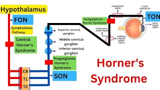 Clinical Case Study Horners Syndrome and Pancoast Tumor [upl. by Nolan]