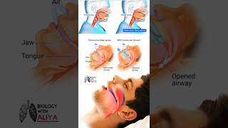 sleep apnea surgery or sleep apnea treatment  3d medical animation short  BiologywithAliya [upl. by Howell]