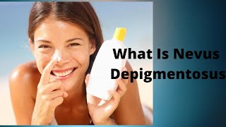 What Is Nevus Depigmentosus [upl. by Heins]