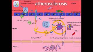 Arteriosclerosis types  Atherosclerosis  PathogenesisStages and Complications [upl. by Ardnauq226]