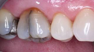 V1904 Reliable Simple Treatment of Cracked Teeth [upl. by Nylacaj]