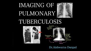 Imaging of pulmonary tuberculosis A detailed radiologic review  Checklist for reporting [upl. by Llennor]