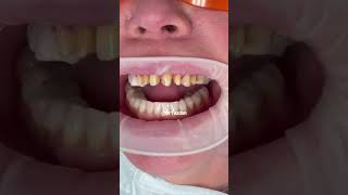 Dental crowns on front teeth  dental crown procedure front tooth  porcelain veneers  Dr Yazdan [upl. by Friedrich]