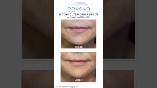 How the Botox Lip Lift Works smile [upl. by Garibull]