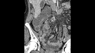 Appendicitis  perforated  complicated  appendicoliths present [upl. by Aihsekat511]