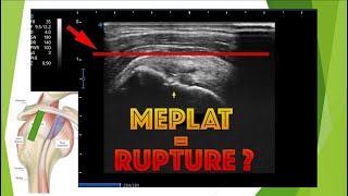 Signe du méplat en échographie du supra épineux [upl. by Cigam]