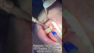 Wisdom Tooth Removal dentaltreatment painless wisdomteeth wisdomtoothremoval nusentral [upl. by Eyde95]