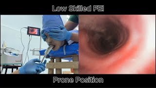 combination of flexible and supraglottic airway device on a patient in prone position [upl. by Xanthus239]