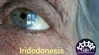 Iridodonesis Clinical Signs shorts Subluxation of Lens [upl. by Anetsirhc145]