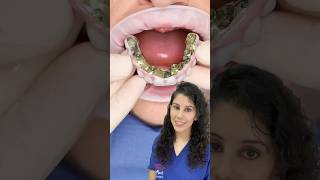 Implants Supported Fixed Teeth implants shorts dental viralvideo trending implantdenture [upl. by Daveta]