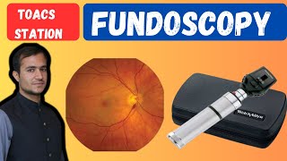 Fundoscopic examination  Fundoscopy made easy  Fundoscopy procedure  Fundoscopy eye test [upl. by Puduns]