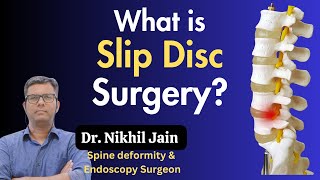 What is Slip Disc Surgery How Endoscopic amp Microscopic Techniques Ensure Success in Spine Surgery [upl. by Echo547]