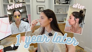 The Truth About My Rhinoplasty 1 year later [upl. by Nole]