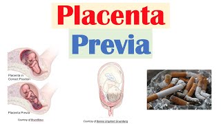 Placenta Previa Low Lying Placenta  Risk Factors Symptoms amp Complications Diagnosis Treatment [upl. by Sutit]