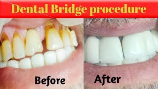 fixed dental bridge before and after [upl. by Jc]