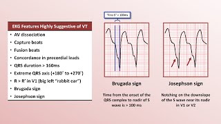 Advanced EKGs  Distinguishing VT from SVT with aberrancy [upl. by Winfred]