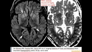 56 Hypoglycemic encephalopathy low glucose thalamic sparing insulin shock therapy [upl. by Oirramed]