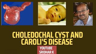 Choledochal cyst and Carolis disease Neonatal cholestasis choledochalcyst carolidisease [upl. by Letty]