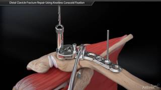 Distal Clavicle Fracture Repair Using Coracoid Fixation [upl. by Chas]