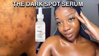 HOW TO GET RID OF DARK SPOTS WITH ONE PRODUCT  The ordinary [upl. by Ert]