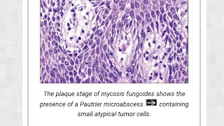 mycosis fungosis [upl. by Hakim]